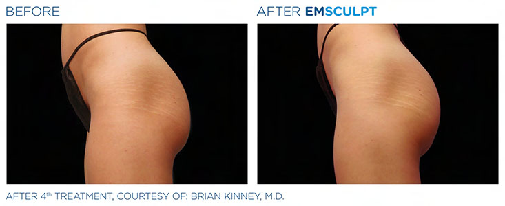 Evolys - Emsculpt fesses