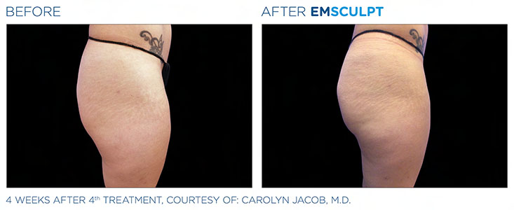Evolys - Emsculpt fesses