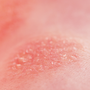 Psoriasis